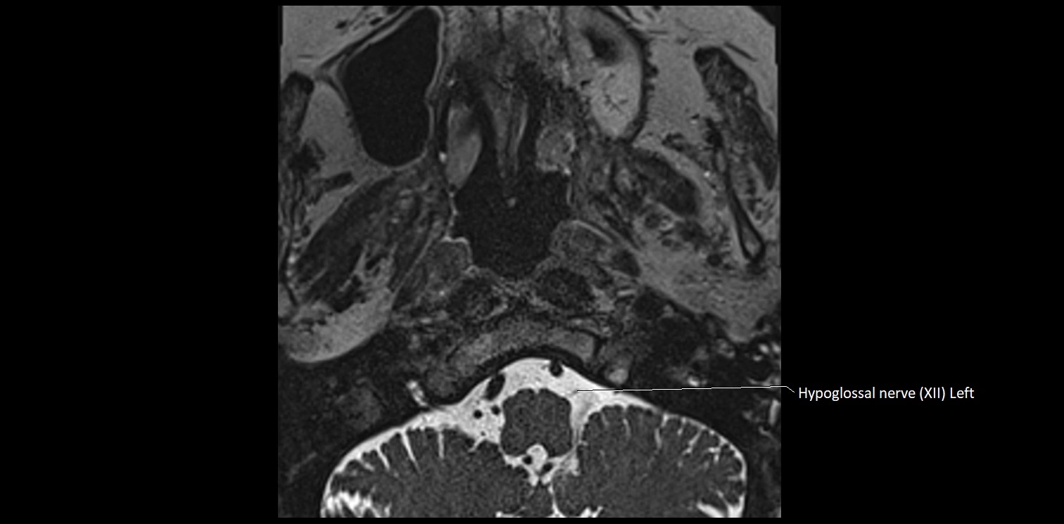 Cranial nerve anatomy axial MRI 3T image 77.webp